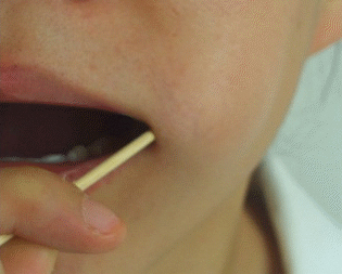 口腔拭子采样 口腔拭子采样