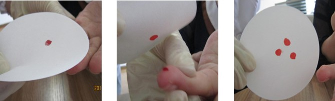 血痕采样 血痕采样